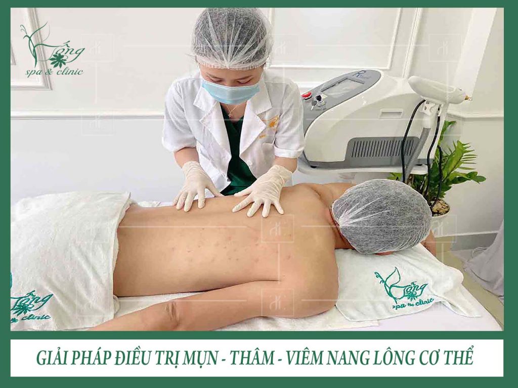 Trị Vết Thâm ở Chân Lâu Năm : Laser + Tảo Sylic #2023