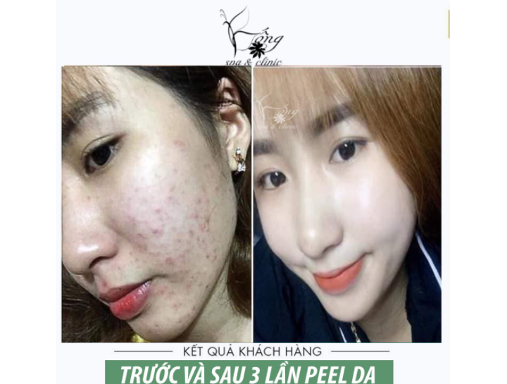 Peel Da Sinh Học là gì? Tác dụng gì ? Phù hợp với ai [2022]