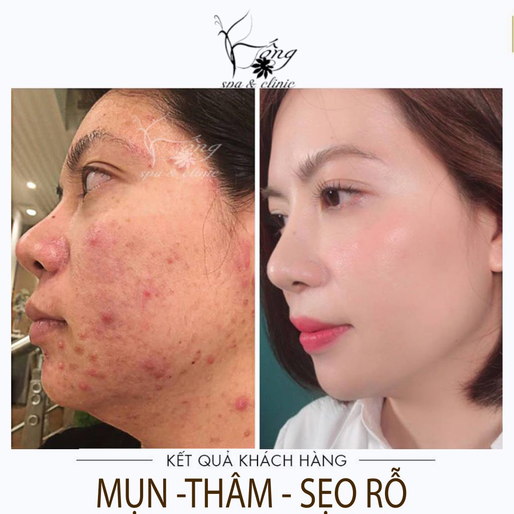 Trị Sẹo Rỗ Hết Bao Nhiêu Tiền ? Bảng giá PRP trị sẹo [2023]