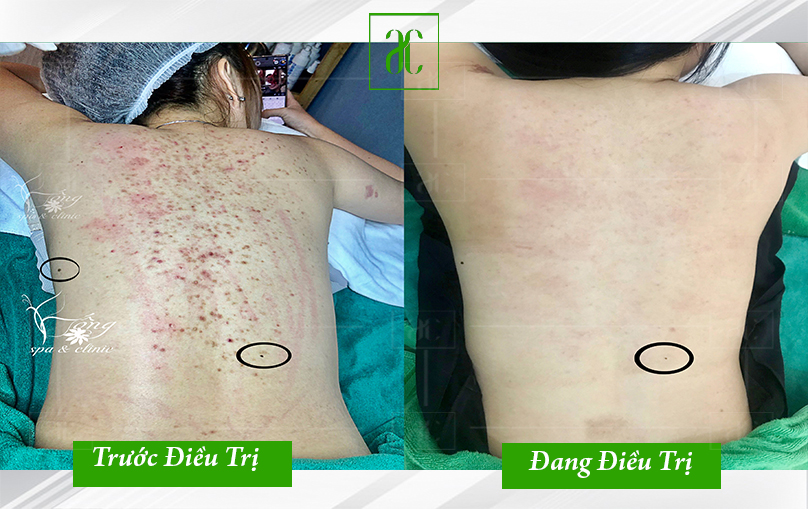 cách trị mụn lưng cấp tốc hiệu quả tại nhà