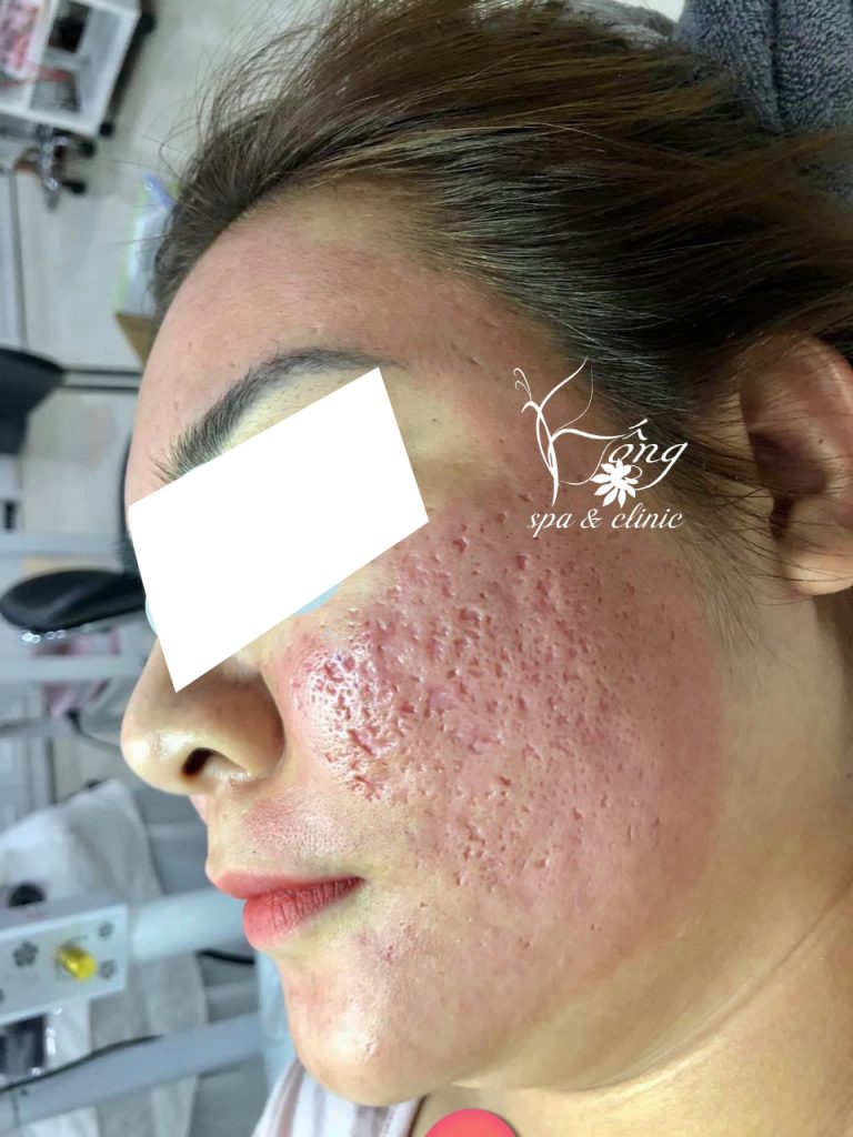 Lăn Kim Trị Sẹo Rỗ PRP 4.0 - Sẹo có hồi không ?Giá Bao Nhiêu