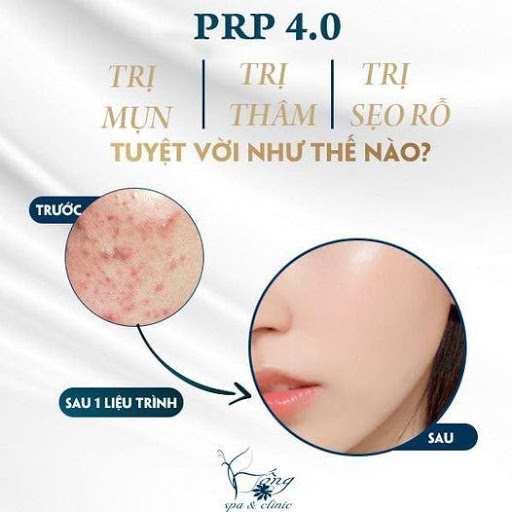 Trị Sẹo Rỗ Hết Bao Nhiêu Tiền ? Bảng giá PRP trị sẹo [2023]