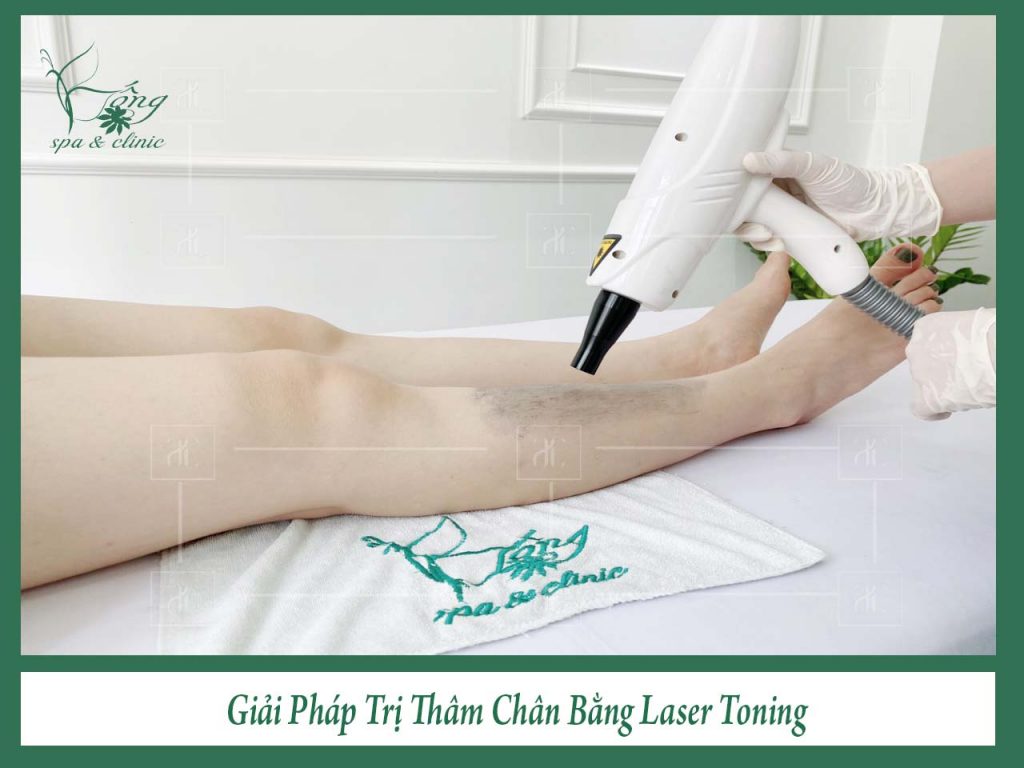 Trị Sẹo Thâm Chân Bằng Laser Toning -Uy tín số 1 tại TPHCM..