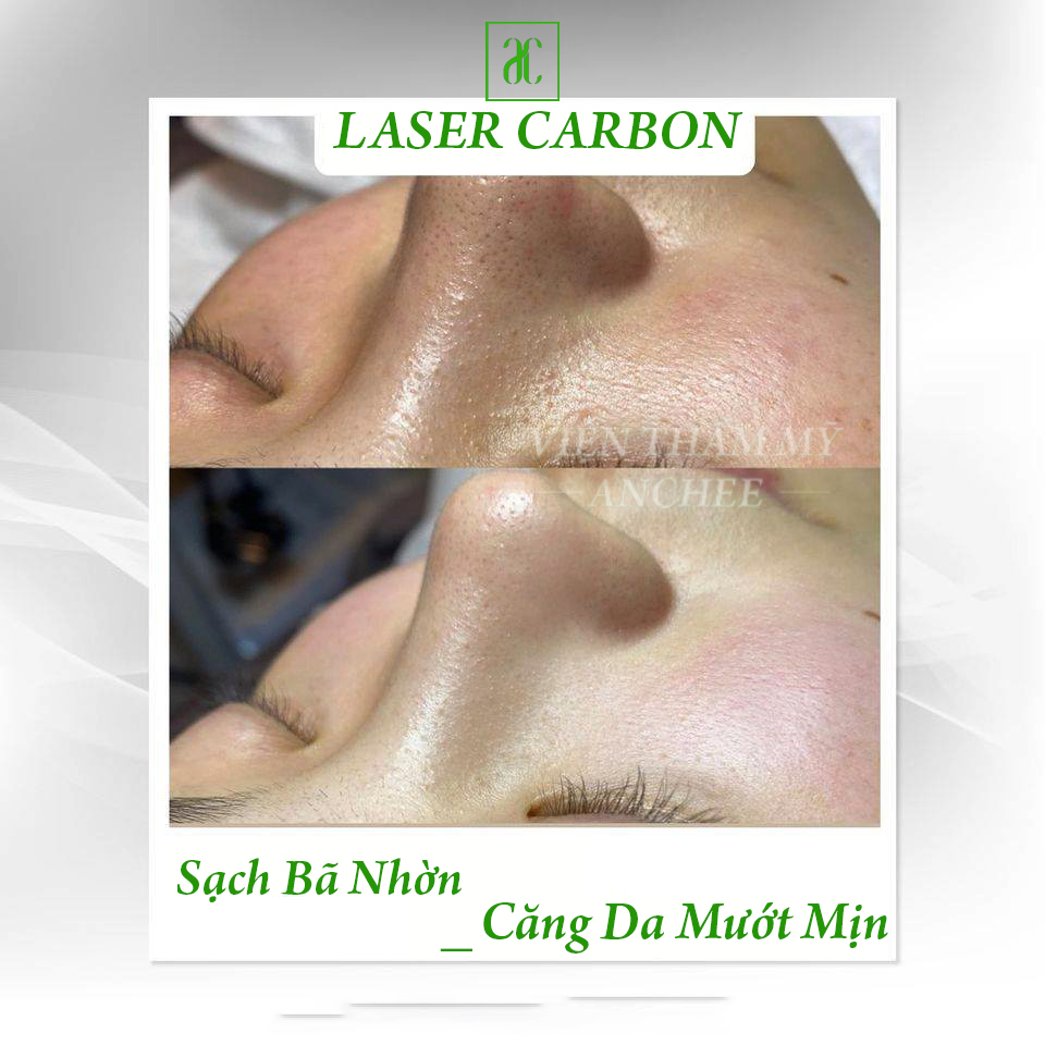 Bắn Laser Carbon có tốt không? Bao Nhiêu Tiền? Lưu Ý [2022]