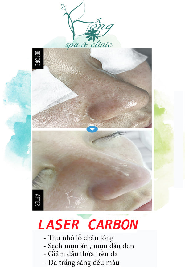 ban-laser-carbon-co-tot-khong