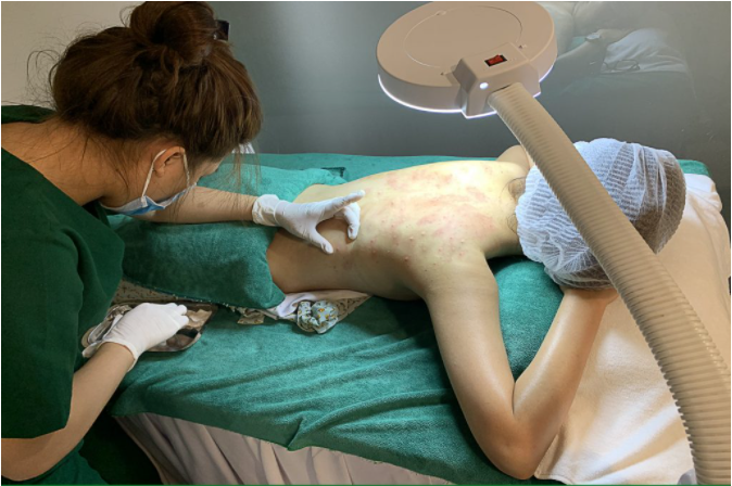 Lăn Kim Trị Mụn Lưng có tốt không? Quy Trình - Bảng Giá 2023