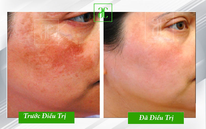 điều trị nám