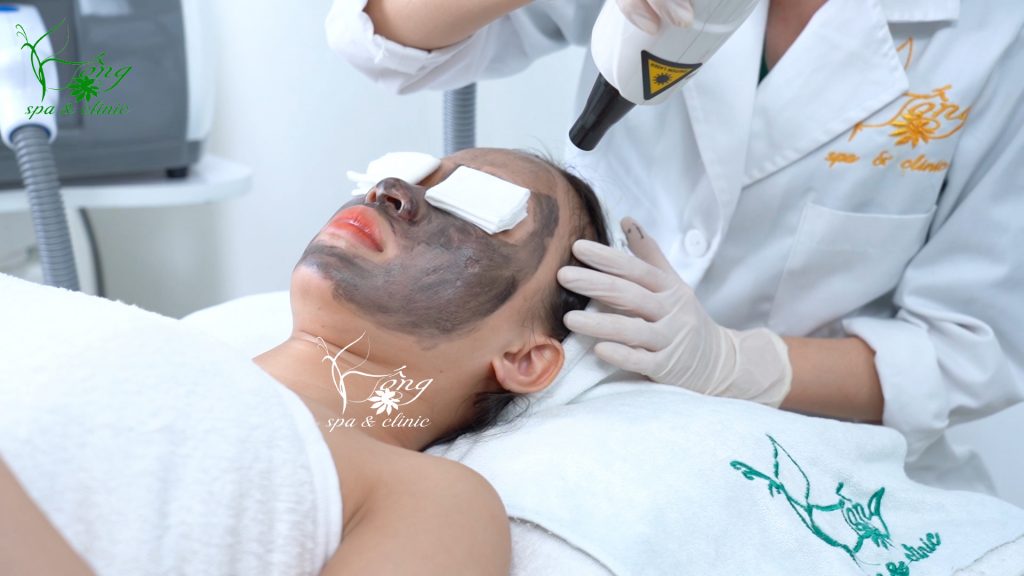 Bắn Laser Carbon có tốt không? Bao Nhiêu Tiền? Lưu Ý [2022]