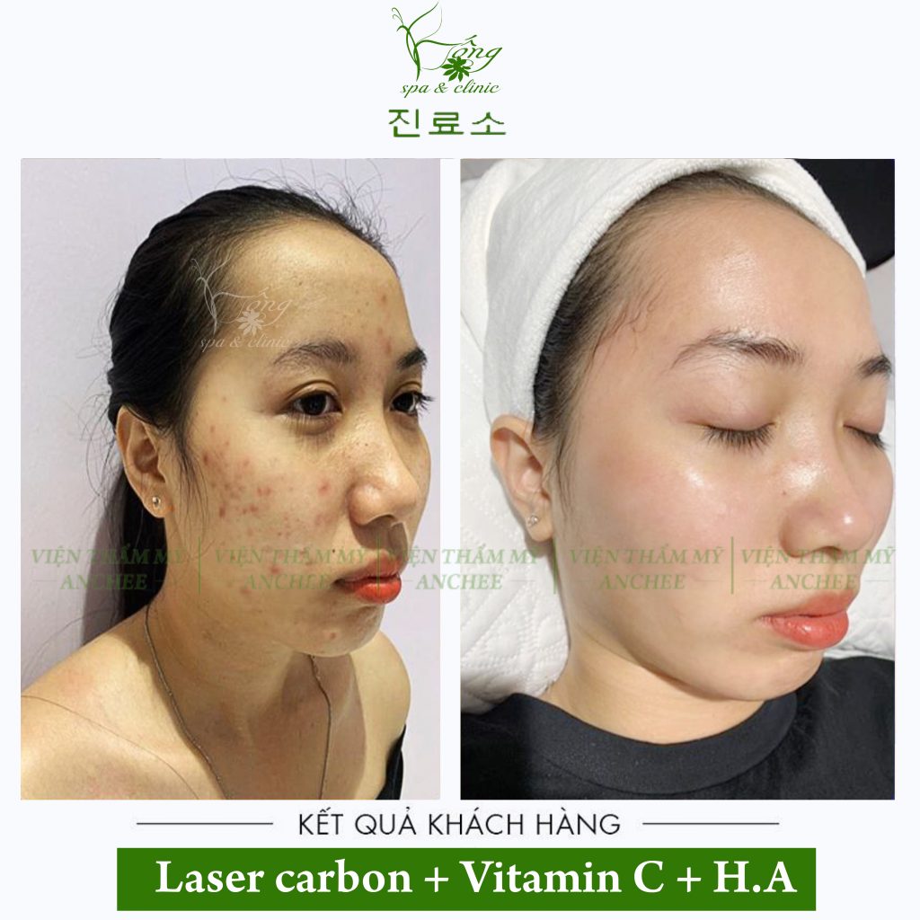 Bắn Laser Carbon có tốt không? Bao Nhiêu Tiền? Lưu Ý [2022]