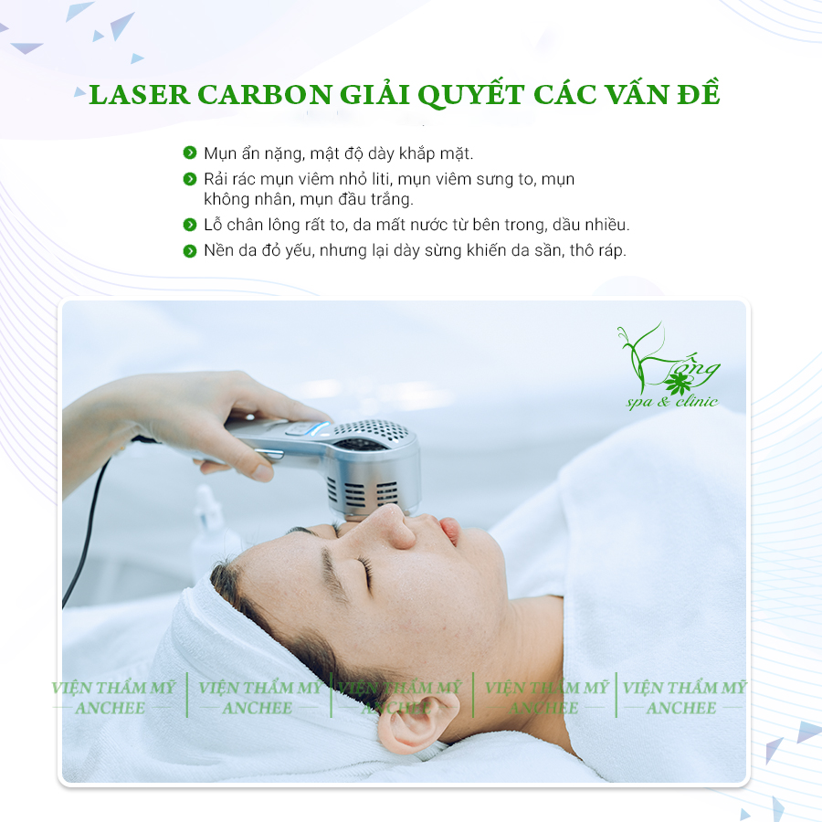 Bắn Laser Carbon có tốt không? Bao Nhiêu Tiền? Lưu Ý [2022]