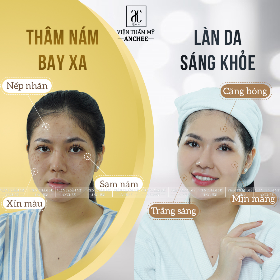 Làm thế nào để điều trị nám chân sâu bằng laser?
