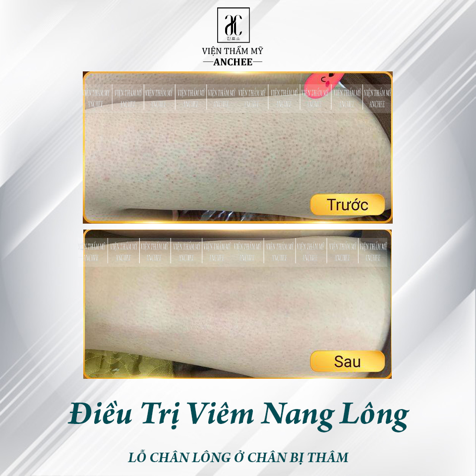 Spa Trị Viêm Nang Lông Bằng Laser Bao Nhiêu Tiền - Giá 2023