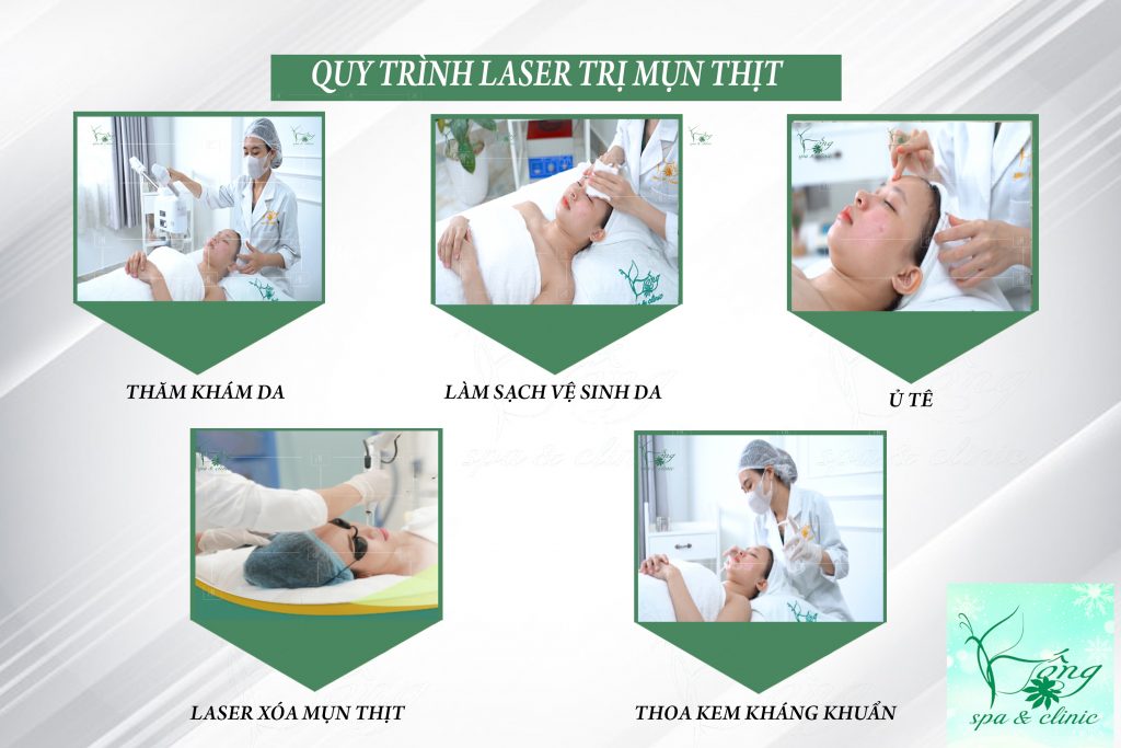 Spa Trị Mụn Thịt Bằng Laser 1 Lần Duy Nhất - Chỉ 50K/Nốt