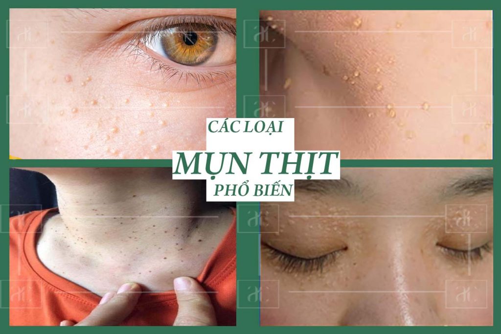 Spa Trị Mụn Thịt Bằng Laser 1 Lần Duy Nhất - Chỉ 50K/Nốt