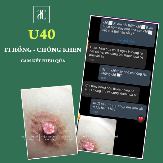 Làm Hồng Nhũ Hoa bằng Laser bao nhiêu tiền? Bảng giá 2023