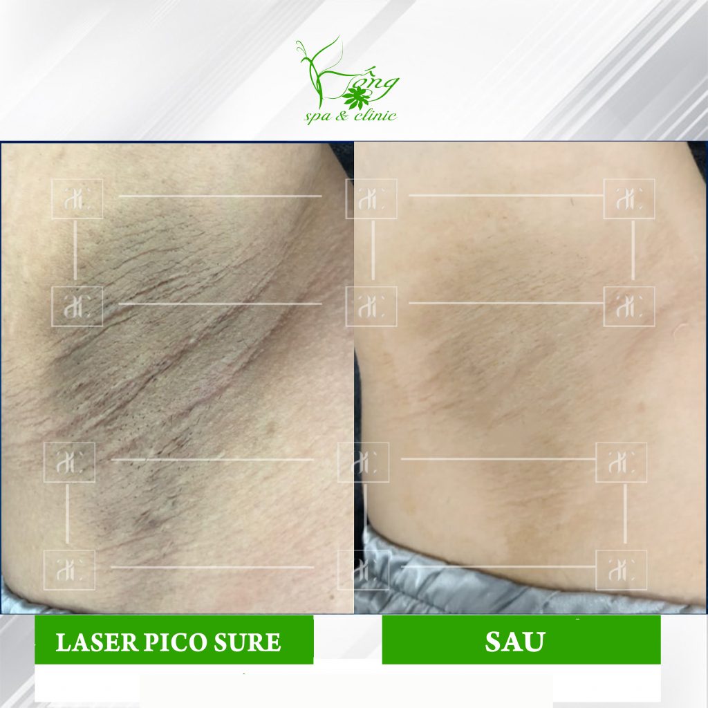 Spa Trị Thâm Nách Bao Nhiêu Tiền ? Laser + Bio chỉ #299K