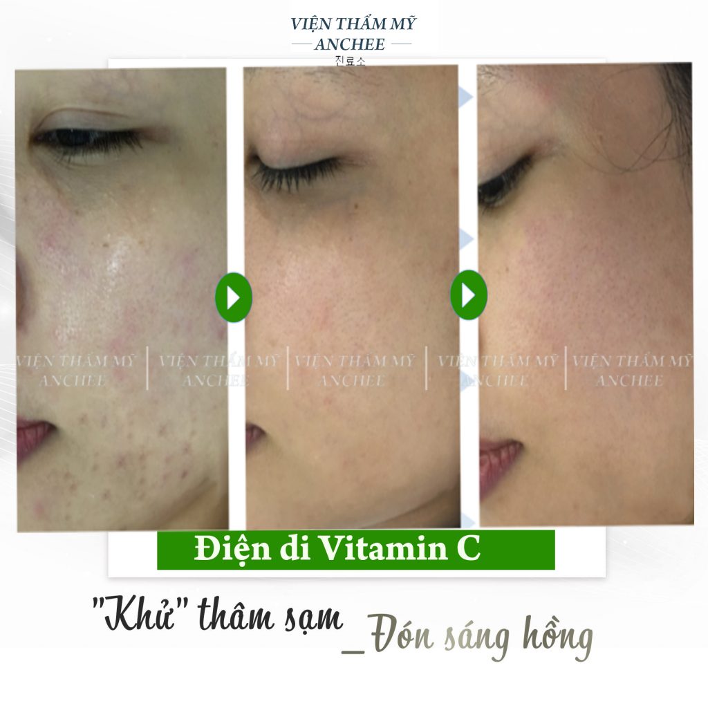 Điện Di Vitamin C Tác Dụng Gì ? Quy Trình - Bảng Giá [2023]