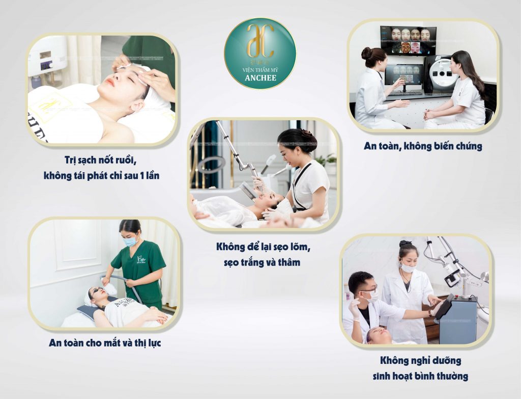 Tẩy Nốt Ruồi Bằng Laser chỉ 50k/nốt Không Đau - Không Sẹo