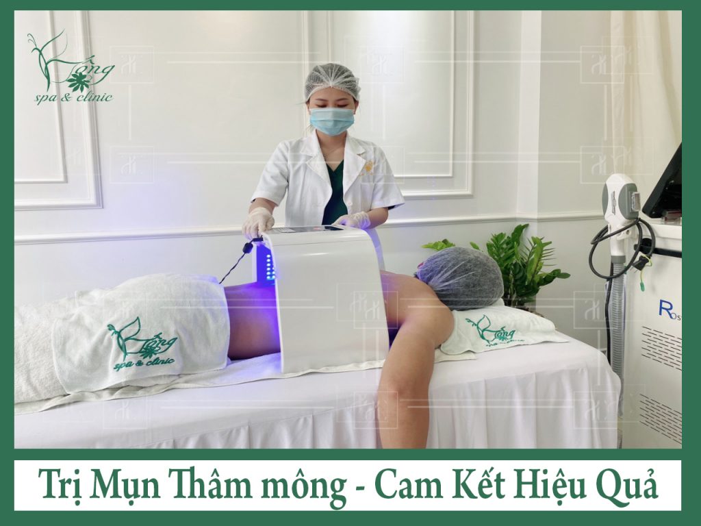 Spa trị thâm mông cho Nam Giới : Laser + Điện Di Tế Bào Gốc