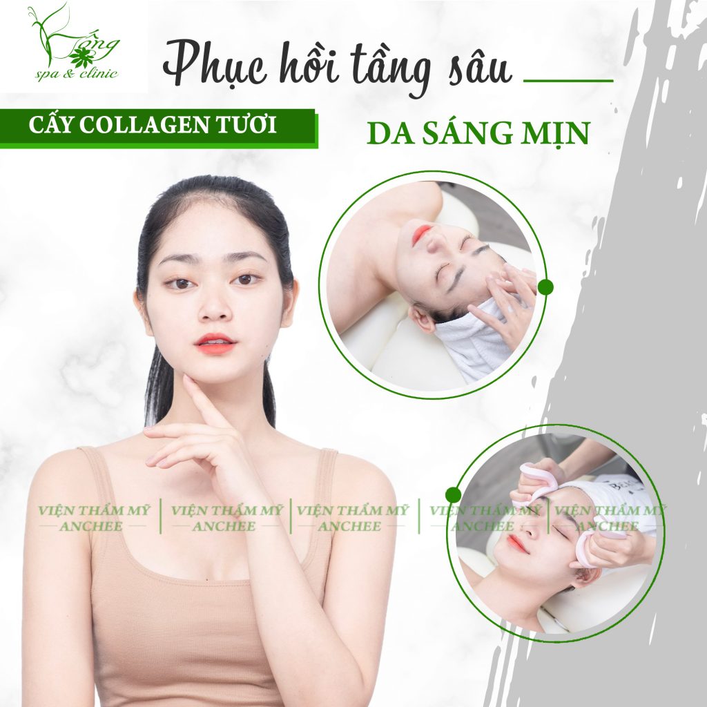 Cấy Collagen Tươi Giá Bao Nhiêu ? Có Tốt Không ? [2022]