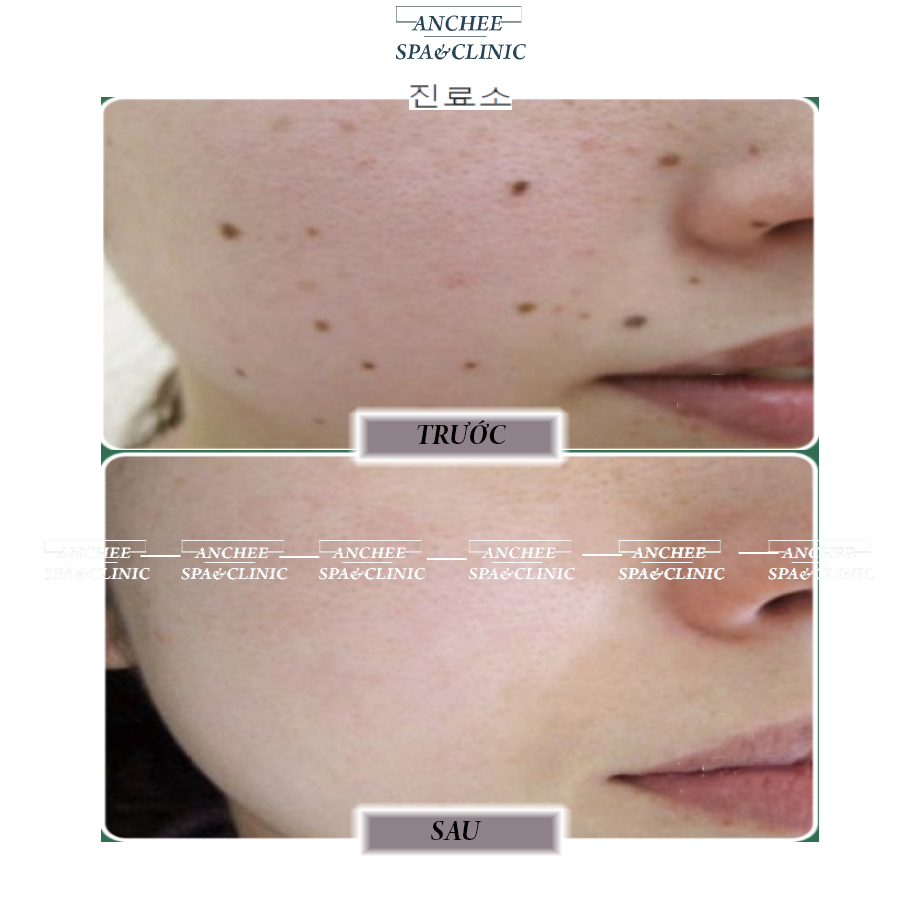 Top 5+ Cách Tẩy Nốt Ruồi Cấp Tốc trong 1 ngày cưc dễ [2022]