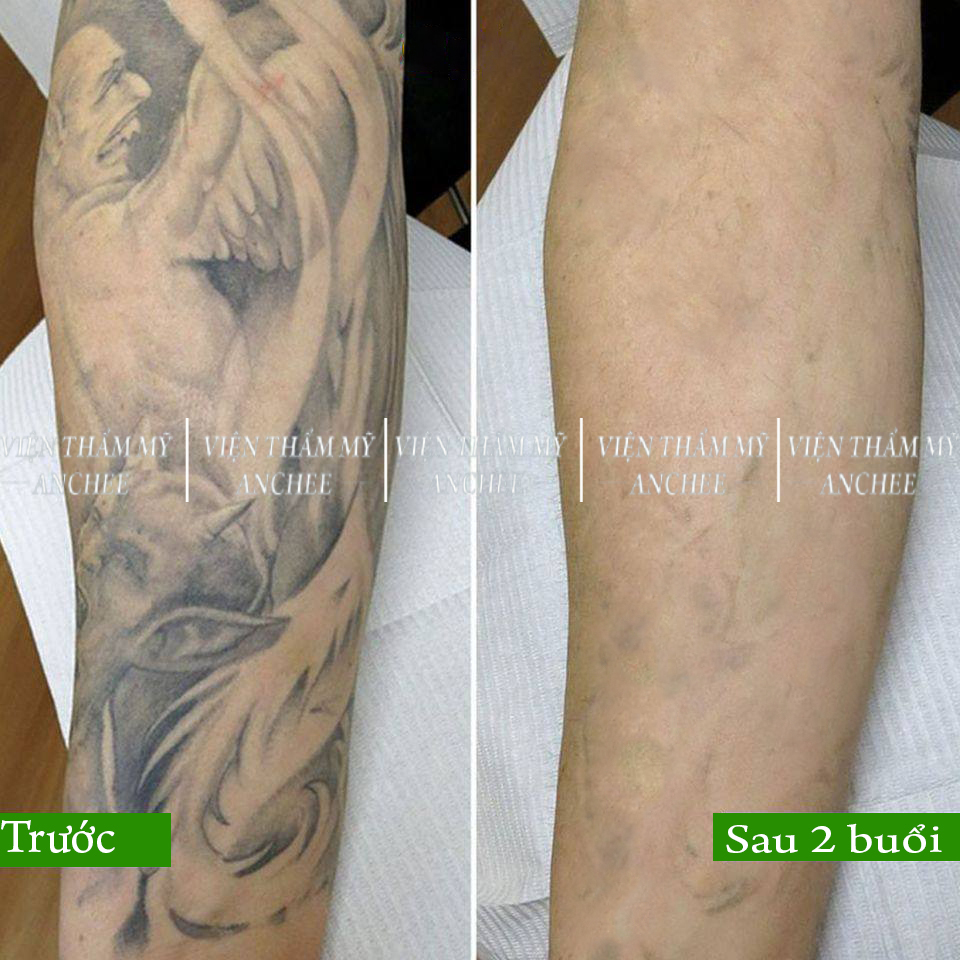 Anh Tú Tattoo  Tẩy xóa hình xăm  Vinh Nghệ An  Vinh