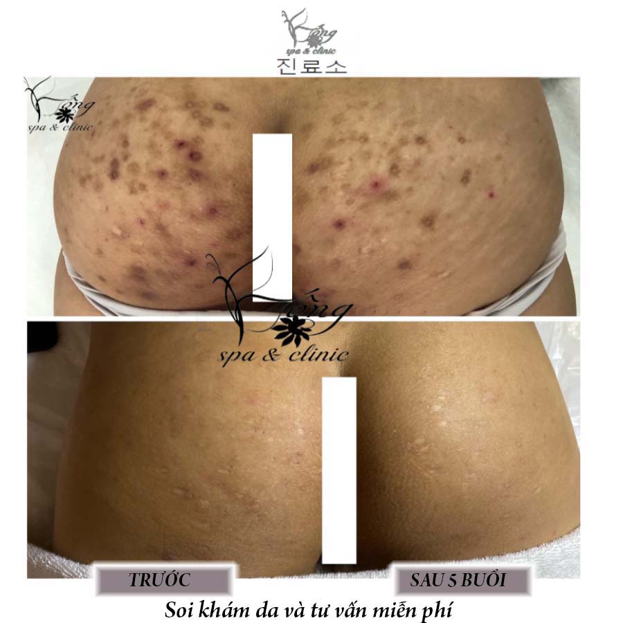 Mụn Bọc ở Mông - Nguyên nhân và 7 Cách điều trị tại nhà 2023