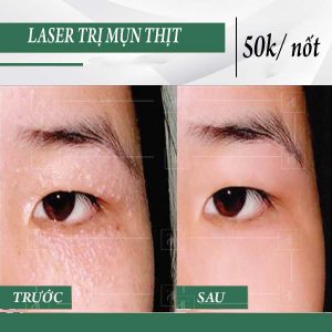 Có những loại thuốc và sản phẩm chăm sóc da nào được sử dụng trong điều trị mụn thịt quanh mắt?
