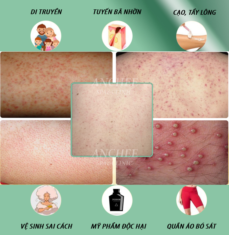 Nổi Mụn ở Ngực - Nguyên Nhân & 3 Cách Trị Tại Nhà [2023]