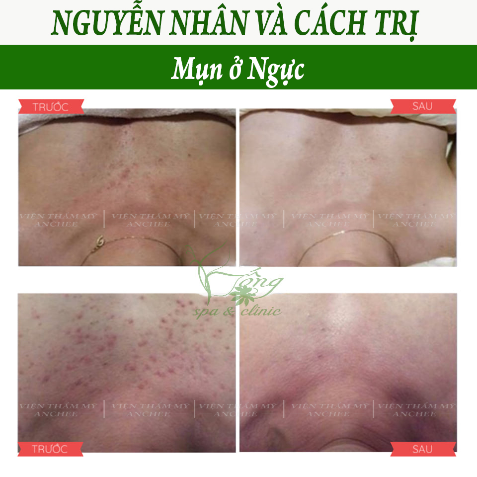 Nổi Mụn ở Ngực - Nguyên Nhân & 3 Cách Trị Tại Nhà [2023]