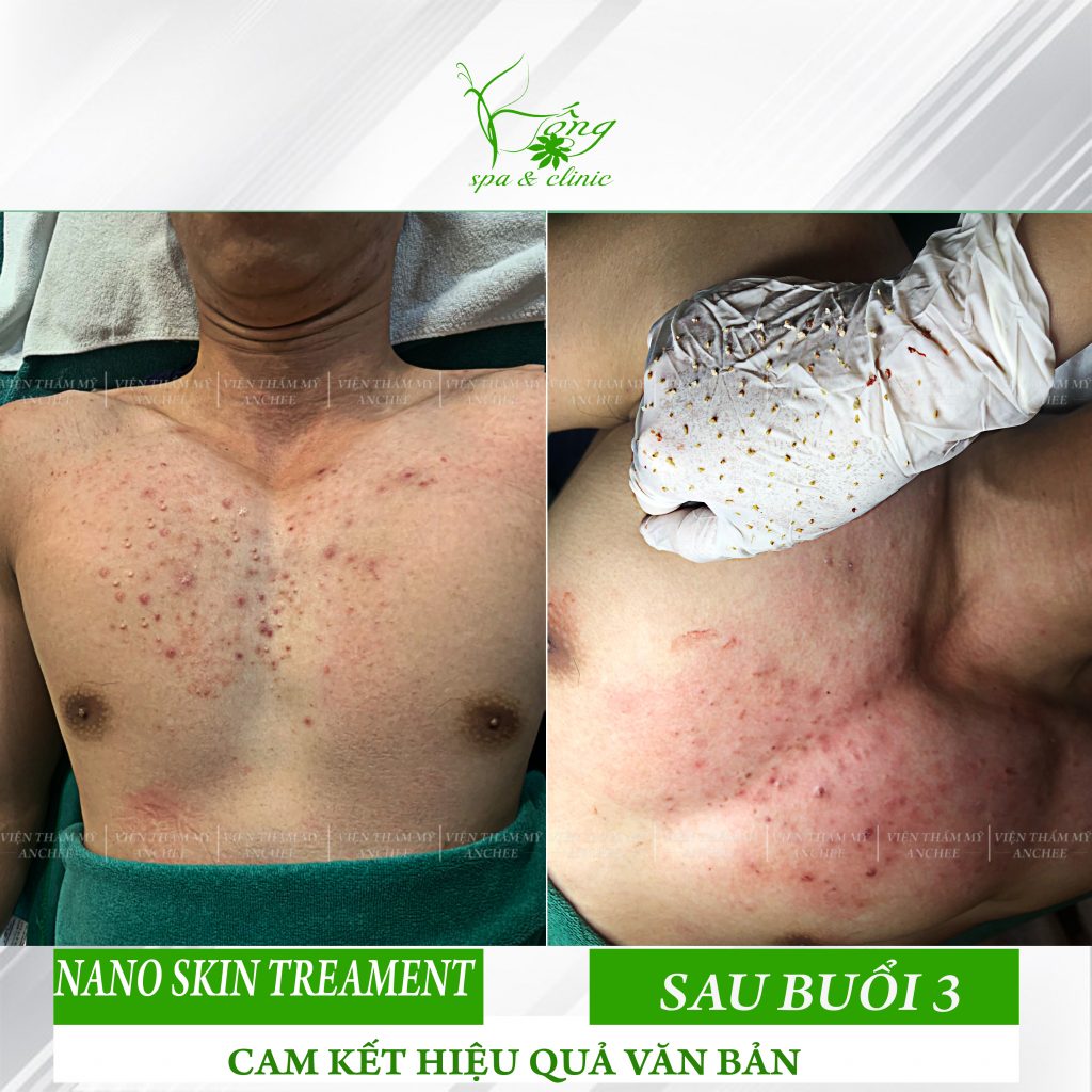 Điều Trị Mụn Lưng ở Đâu Hiệu Quả - Bao Nhiêu Tiền ? [2023]