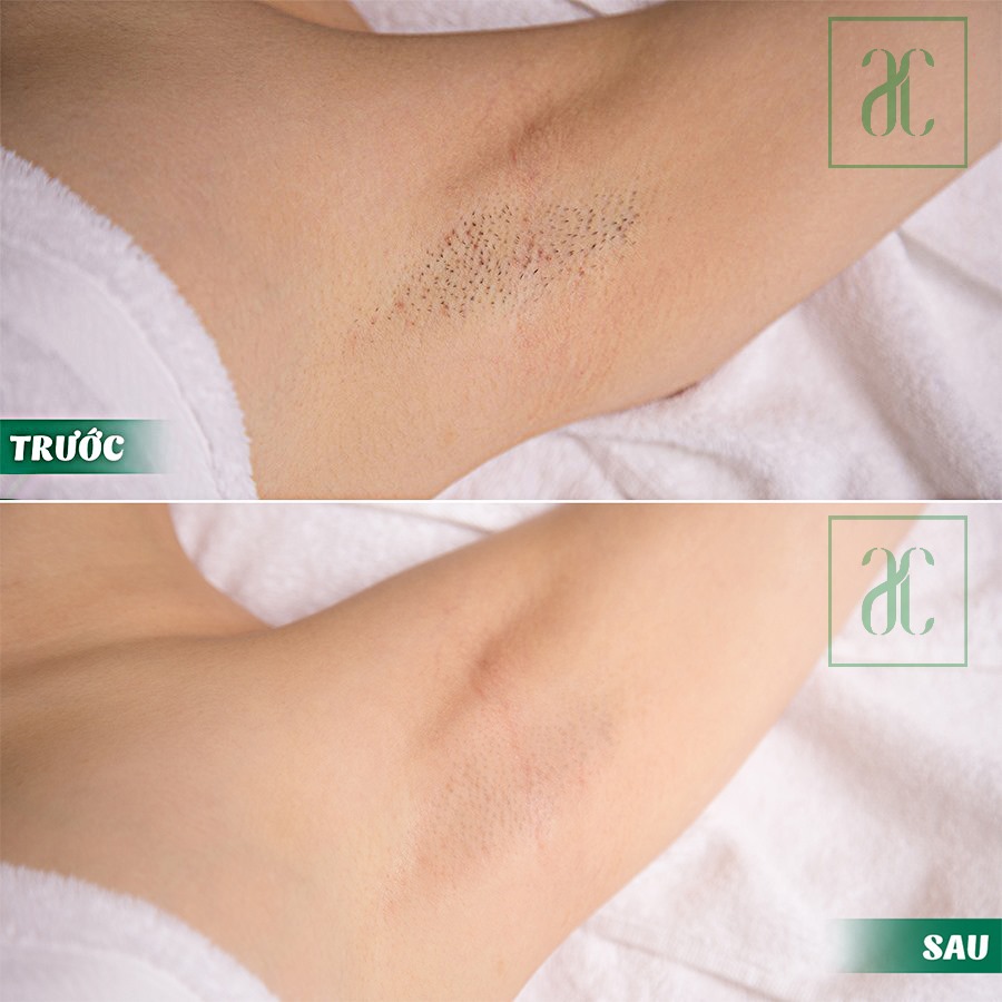 Triệt Lông Toàn Thân Vĩnh Viễn Giá Bao Nhiêu? Chỉ 699K/buổi