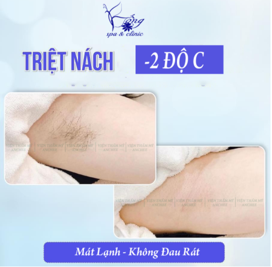 Triệt Lông Toàn Thân Vĩnh Viễn Giá Bao Nhiêu? Chỉ 699K/buổi