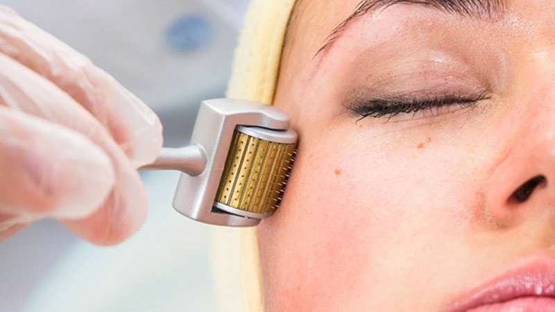 Lăn Kim Trị Mụn tốt không? Làm mấy lần? Giá bao nhiêu? 2023