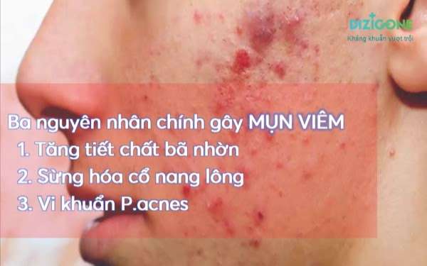 Kem Trị Mụn Derma Forte - Ưu Nhược Điểm & Cách dùng #2022