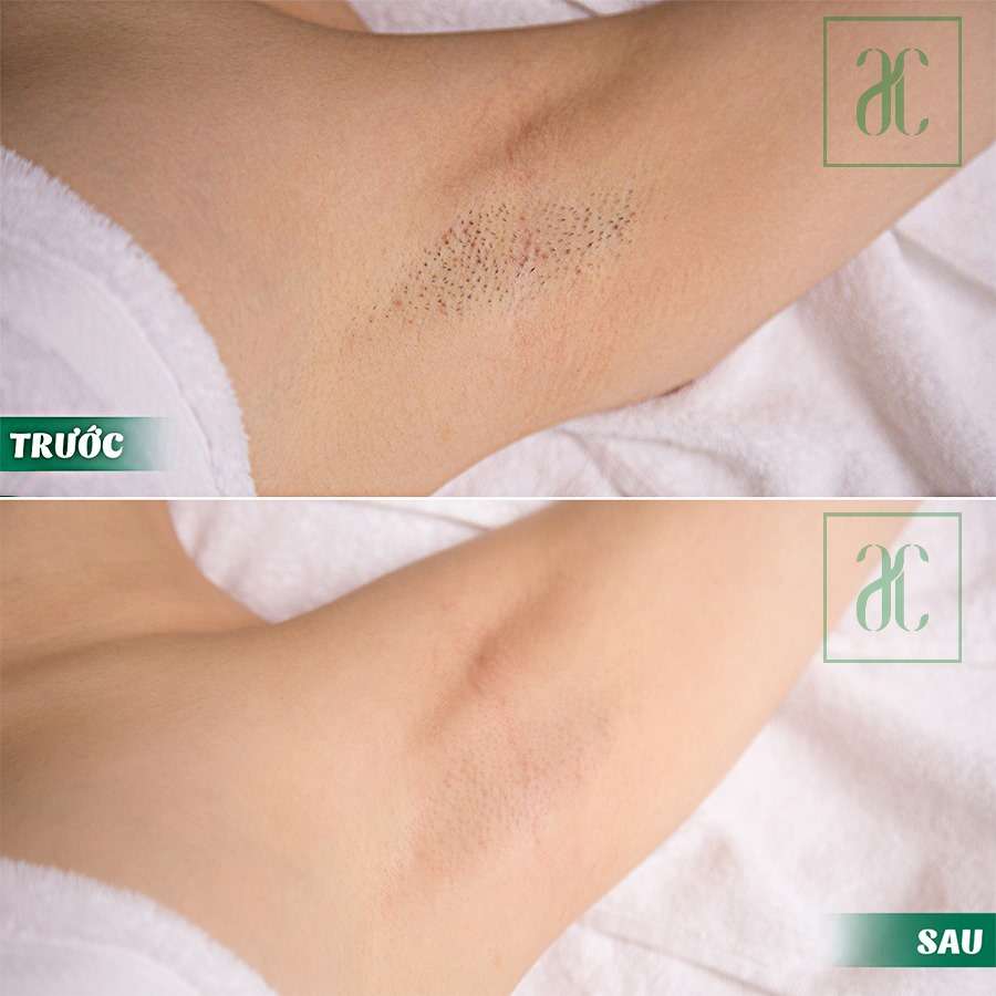 Top 7 cách wax lông nách tự nhiên tại nhà : Sạch - Mịn 2022