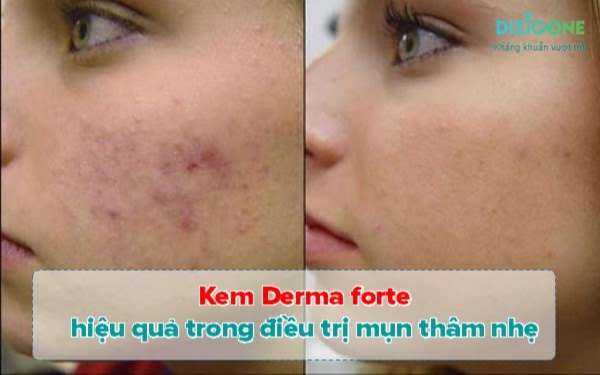 Kem Trị Mụn Derma Forte - Ưu Nhược Điểm & Cách dùng #2022