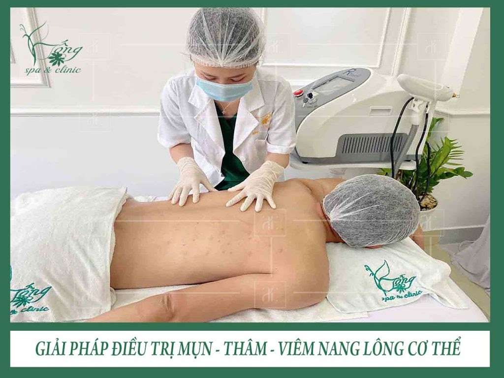 Điều Trị Mụn Lưng ở Đâu Hiệu Quả - Bao Nhiêu Tiền ? [2023]