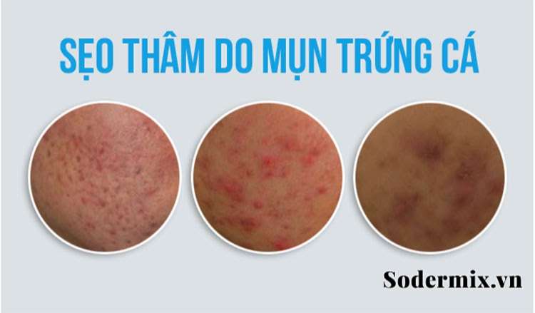 [Top] 5 Cách Làm Sẹo Thâm Biến Mất Sau 1 Tuần tại nhà #2022