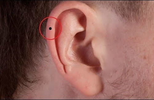 Có những nguyên nhân gây ra sự xuất hiện của mụn ruồi ở vành tai phải nam?
