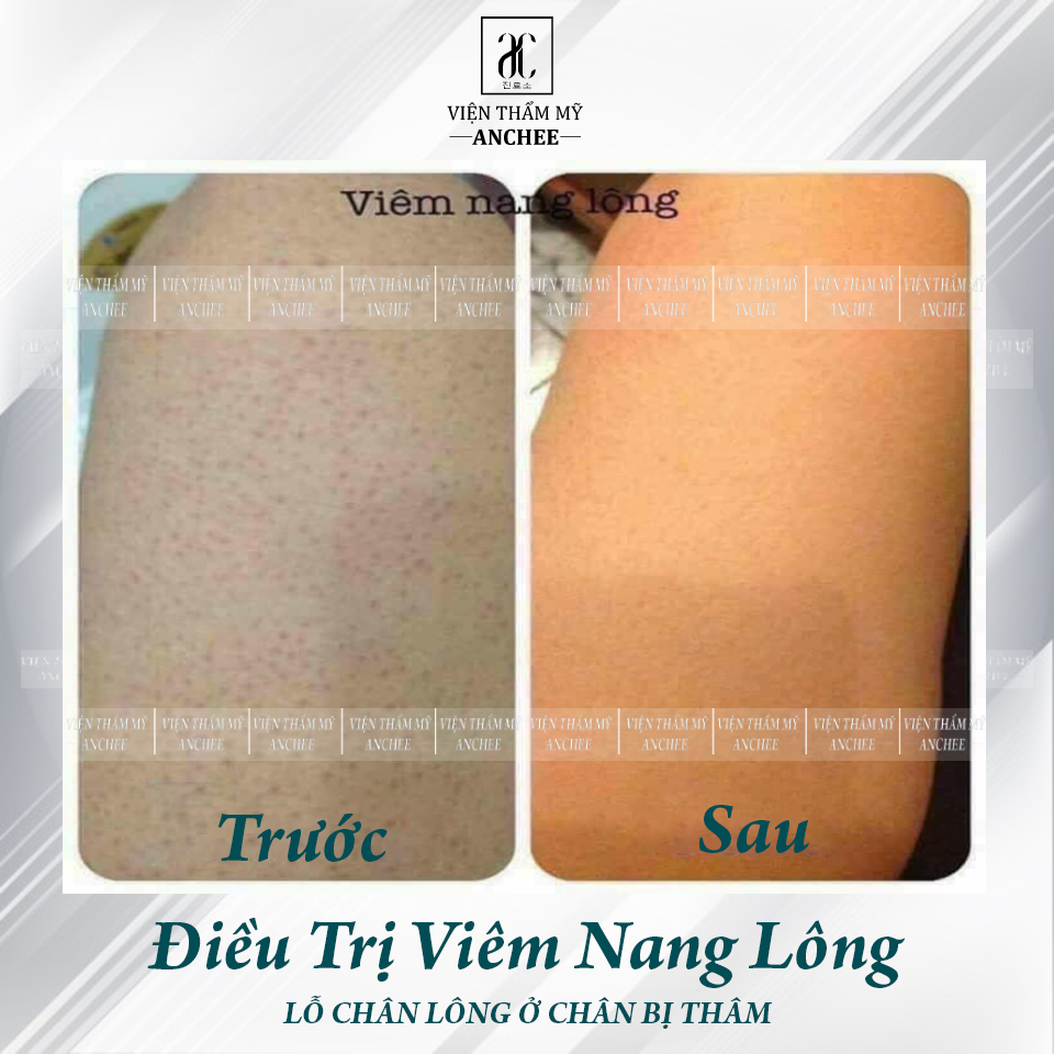 8+ Cách Trị Viêm Nang Lông ở Đùi hiệu quả sau 1 tuần 2023