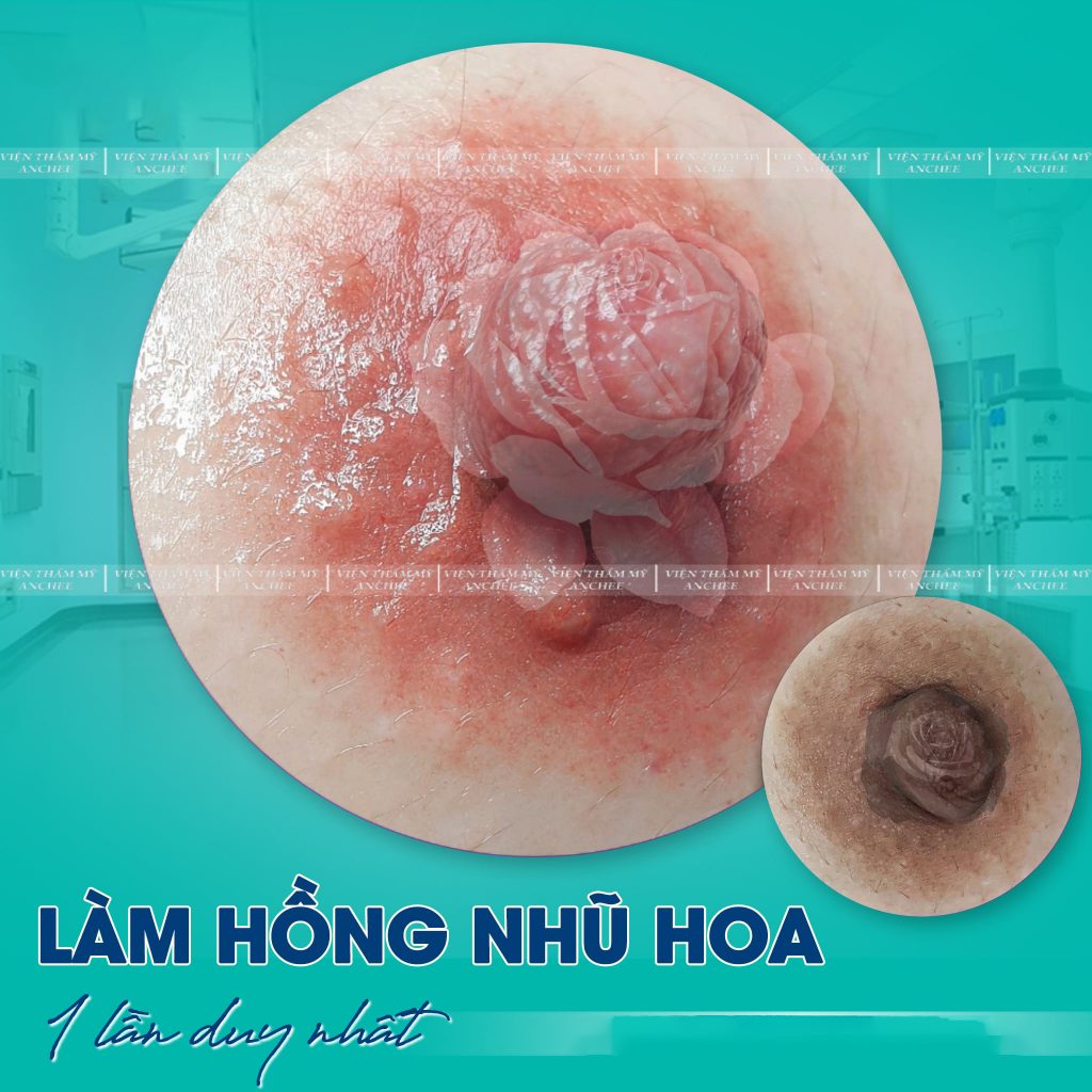 Làm Hồng Nhũ Hoa bằng Laser bao nhiêu tiền? Bảng giá 2023