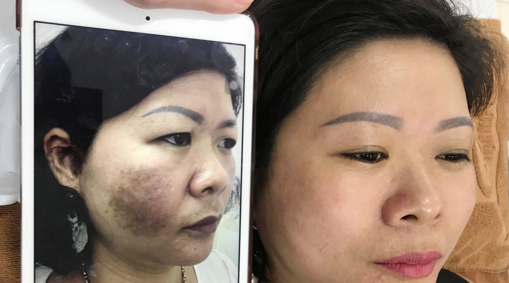 Xóa bớt bẩm sinh giá bao nhiêu tiền bằng Laser?Bác sĩ tư vấn