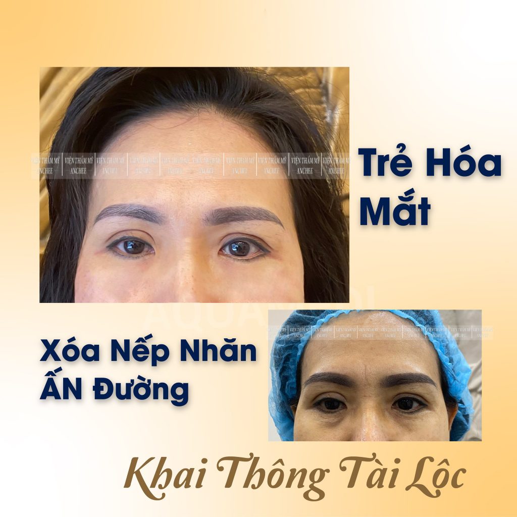 Liệu trình trẻ hoá da mặt giá bao nhiêu? Làm ở đâu tốt? 2023