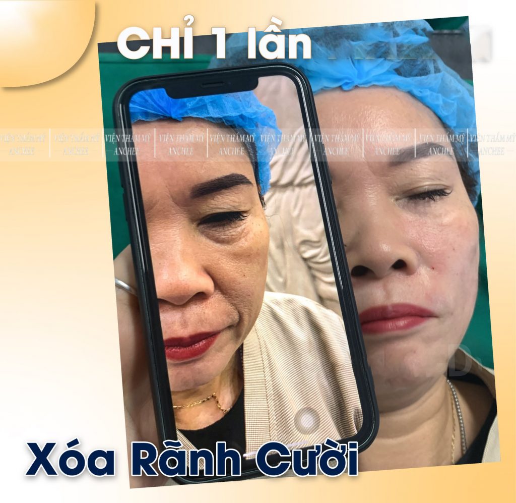 Liệu trình trẻ hoá da mặt giá bao nhiêu? Làm ở đâu tốt? 2023