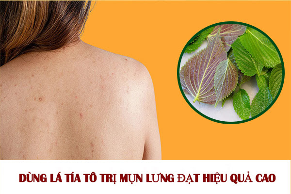 Tắm lá gì trị mụn lưng ? Tía Tô , Trà Xanh [hiệu đến quả 99%]