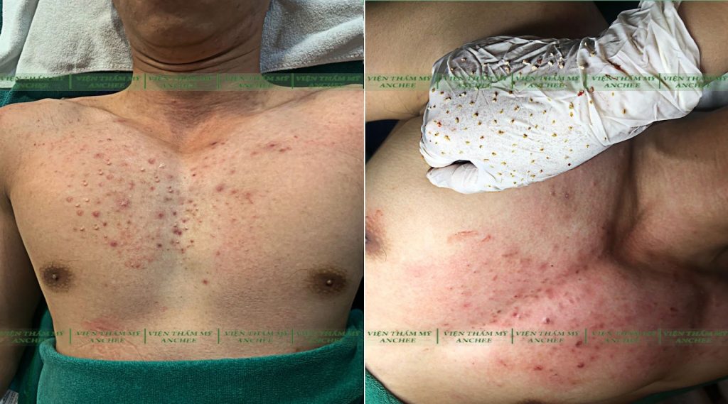 8+ Cách Trị Mụn ở Ngực và Lưng hiệu quả Cấp Tốc sau 3 ngày
