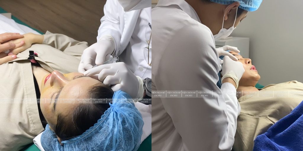 Tiêm Collagen Vùng Mắt : Ưu nhược điểm - Chi Phí - Bảng Giá