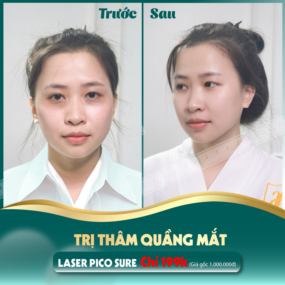 Laser xóa quầng thâm mắt vĩnh viễn giá bao nhiêu tiền ? 2022