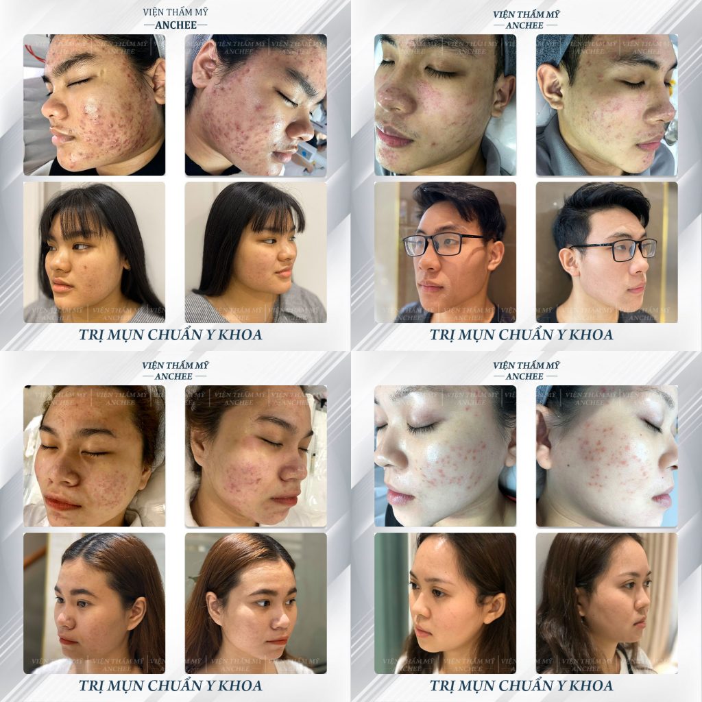Top 12+ Spa Trị Mụn Quận 10 TPHCM: Hiệu Quả - Bảng Giá 2023